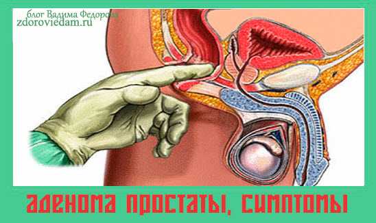 adenoma-prostaty-simptomy