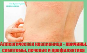 allergicheskaya-krapivnitsa