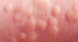 allergiya-na-holod-voldiri-krapivnici