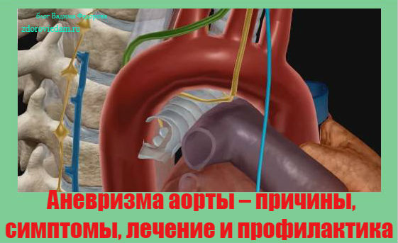 anevrizma-aorty