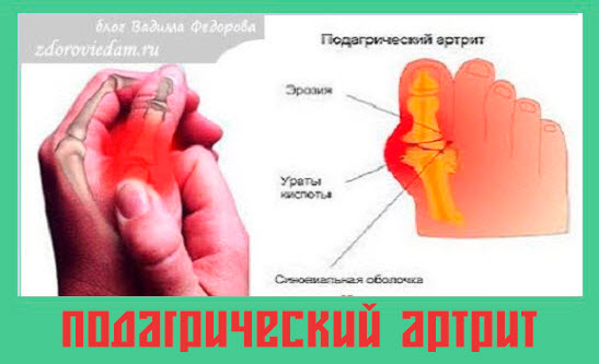 podagricheskij-artrit
