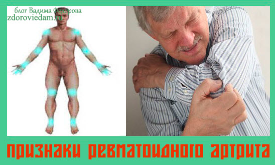priznaki-revmatoidnogo-artrita